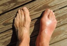 Dyve Biosciences (Private) Receives FDA Clearance to Begin Phase 2 Study of DYV-700 for Treatment of Acute Gout Pain. Biotech Stock Review, Dyve Pharma