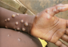 Is There Enough Monkeypox (Mpox) Vaccine to go Around? Maybe yes, More Likely no.