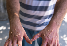 Mpox Vaccines and ‘Emergency Use’ Authorization Explained.