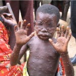GeoVax (GOVX) Monkeypox (MPOX) PowerPoint.