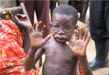 GeoVax (GOVX) Monkeypox (MPOX) PowerPoint.