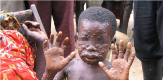 GeoVax (GOVX) Monkeypox (MPOX) PowerPoint.