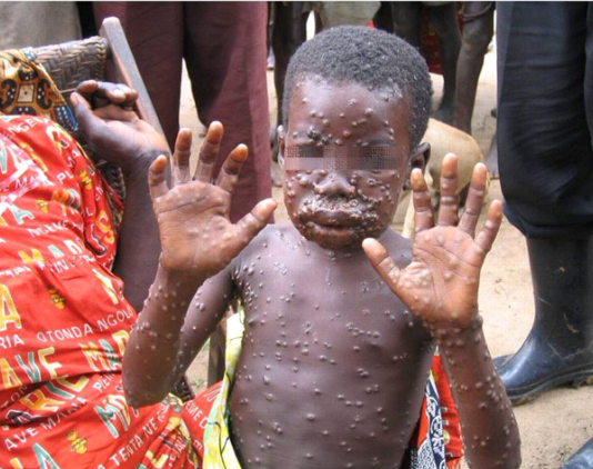 GeoVax (GOVX) Monkeypox (MPOX) PowerPoint.