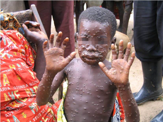 photo mpox